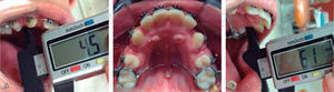 First activation. A. MOP. B. Occlusal. C. Control.