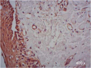 Positive immunoexpression of TGF-β3 in epithelial cells from a patient with complete cleft palate (400x).