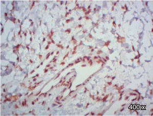 Positive immunoexpression of TGFβ-RIII, in fibroblasts of a patient with cleft palate (400x).