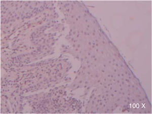 Absent immunoexpression of TGFβ-RIII in epitelial cells of a patient with complete cleft palate (100x).