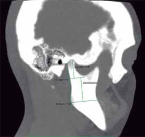 Right sagittal section, mandibular ramus 27.9 mm, condyle 21.3 mm.