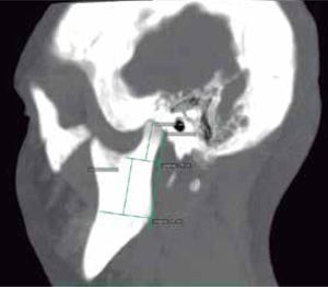 Left sagittal section, mandibular ramus 28.7 mm, condyle 20.1 mm.