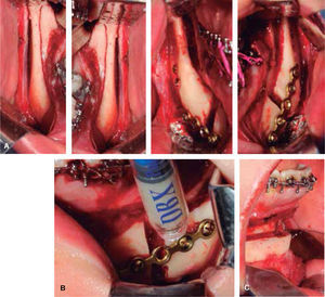 A. Mandibular sagittal osteotomy. B. Bone graft placement. C. Advancement genioplasty.