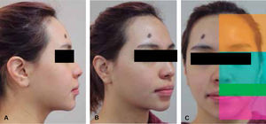 Post-treatment facial photographs: A. Profile. B. Oblique view. C. Vertical proportions.