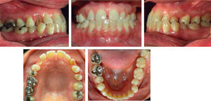 Initial intraoral photographs. Note the bilateral molar class III, the non-assessable canine class due to the presence of deciduous canines, anterior edge-to-edge bite and crossbite at the level of the primary teeth, 0 mm overjet and the presence of upper anterior diastemas. Patient with mixed dentition.