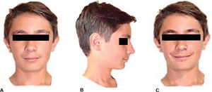 Initial facial evaluation. A. Front, B. Profile, and C. Smile.