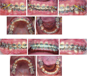 Correction of the deep bite using 0.016” x 0.016” SS reverse curve archwires with intermaxillary elastics.