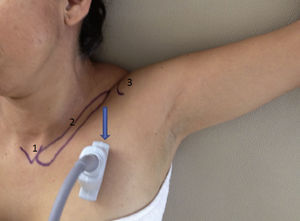 Position of the arm in abduction. The blue arrow shows the input direction of the needle. 1: manubrium; 2: cephalic displacement of the clavicle; 3: humeral head.