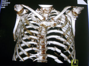 Tomography. Multiple fractures are observed, together with bilateral sternocostoclavicular dislocation.