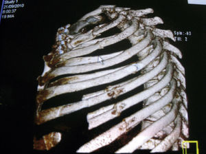 Tomography. Fixation of the rib fracture and the bilateral sternocostoclavicular dislocation are observed.
