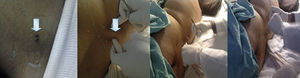 The figure shows, from left to right: the presence of the fistula and the leakage of cerebrospinal fluid by the pressure of the puncture site; likewise, the successful closure of the fistula.