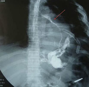 Readmission: the fistulous tract is observed (arrow).