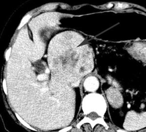 CT scan with contrast material delivered intravenously that shows an 8 cm lesion in the maximum diameter located in the caudate lobe.