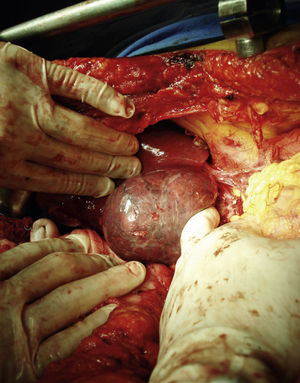 Liver mobilization from an inferior aspect with exposure of the inferior vena cava.