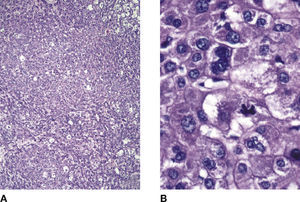 A) Microscopical aspect of the lesion; histopathological report corresponds to a hepatocellular carcinoma (haematoxylin and eosin). B) The lesion has a solid pattern with large neoplastic cells, pleomorphic nuclei, multinucleation and tetrapolar mitosis.