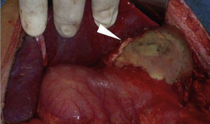 Gastric necrosis in the fundus, body and greater curvature, with posterior gastric ulcer involving the gastric fundus and body.