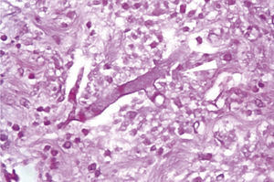 Networks of aseptate hyphae in straight angle, secondary to mucormycosis fungal infection.