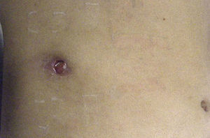 External orifice of cholecysto-cutaneous fistula.