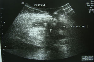 Ultrasound of abdominal wall.