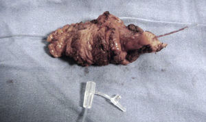 Gallbladder with abdominal wall segment.