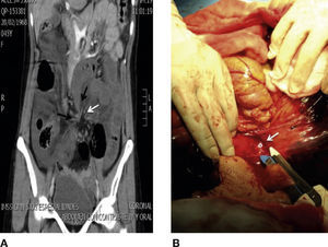 A) Coronal reconstruction of abdominal tomography that evidences fusiform stenosis in terminal ileum and distal colon (peak sign, black arrow), mesentery torsion adjacent to terminal ileum and distal colon (whirlpool sign, black arrow). B) Exploratory laparotomy that shows transmesenteric opening that leads to internal hernia of small bowel and colon.