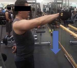 Eccentric exercise for anterior deltoids. The arrow indicates contraction direction.