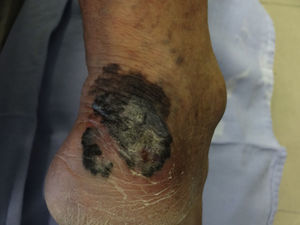 Invasive, thick and ulcerated melanoma, classified as pT4B; clinical evidence is sufficient for diagnosis.
