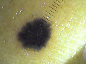 Invasive melanoma greater than 1mm of Breslow's thickness with pseudopods.