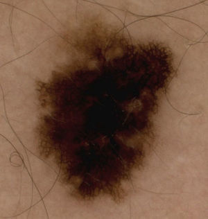 Atypical pigment network and 2-axes asymmetry in an invasive melanoma smaller than 1mm thick.
