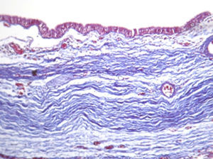 Bronchogenic cyst wall, lined with a pseudo-stratified and cubic ciliated epithelium and discrete oedema of the submucosa. 120× PAS staining.