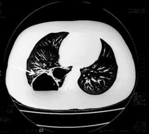 Case 10. The computed axial tomography shows posterior cavity that partially collapses the pulmonary vessels with hydroaerial levels (arrow).