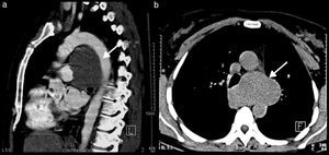 Case 7. (a) Sagittal computed tomography; there is a well-defined mass of homogeneous opacity in front of the aortic arch and the ascending aorta (arrow). (b) Computed axial tomography. The mediastinal mass is projected towards the left, in front of the spinal column, between the ascending and the descending aorta (arrow).