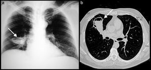 Case 11. (a) Chest X-ray shows a cavity of thin walls with hydroaerial level (arrow). (b) Computed axial tomography shows an irregular cyst image with hydroaerial level in the middle lobe retracted to the front (arrow); Mycobacterium tuberculosis was isolated.