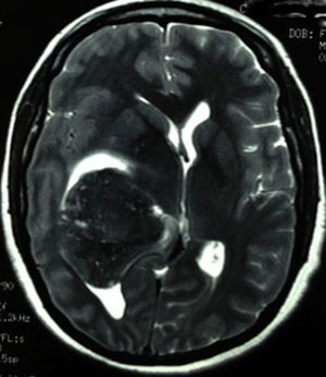 Hypointense lesion in axial T2 magnetic resonance.