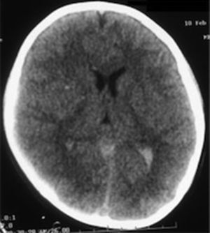 Cranial tomography at admission to the emergency department shows severe cerebral oedema, subarachnoid haemorrhage and major deviation from middle line.