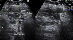 Abdominal ultrasound scan upon admission: abdominal wall mass.