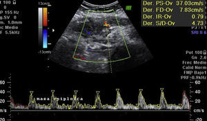 Abdominal ultrasound scan upon admission: increase of vascularisation of the abdominal wall mass with high resistance flows.