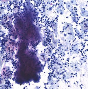 Actinomyces in cervical cytology.