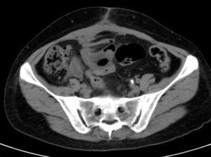 Computed axial tomography 2 months after surgery.