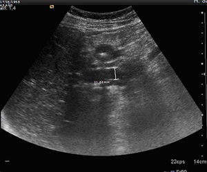 Abdominal ultrasound scan showing the dilatation of the bile duct.