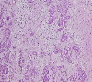 Pancreatic fibrosis.