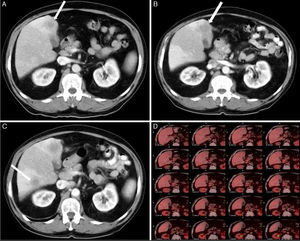(A) Abdominal computed tomography: thickening of the gallbladder walls, with evidence of poorly-defined hypodense lesion of 17mm in diameter in segment IV located in the gallbladder bed. (B) Abdominal computed tomography: persistence of diffuse and unspecific thickening of the gallbladder walls, and growth of the lesion in segment IV, 25mm. (C) Abdominal computed tomography: new lesion in segment VI, 16mm. (D) The positron emission tomography showed no hypermetabolic focuses in the liver indicating malignancy.
