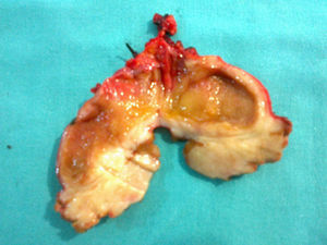 Cholecystectomy piece. Gallbladder with thickened walls and lesions arising from the fundus, without these affecting the mucosa on a macroscopic level.