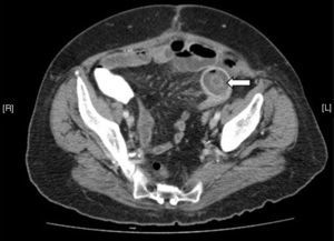 Computed tomography of abdomen shows obstruction of small intestine, secondary to a great gallstone in its interior.