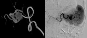 Angiographic study confirming fusiform dilatation located in the distal third of the splenic artery.