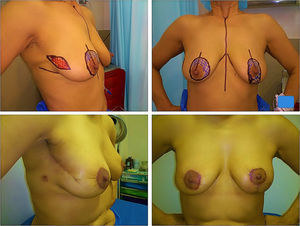 Right breast tumour in 10 radius treated with lateral branch pattern and symmetrisation of contralateral breast with vertical branch pattern.