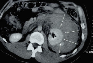 Computed tomography showing retroperitoneal haemorrhage secondary to metastatic lesion of hepatocellular carcinoma in left kidney (white arrows indicate the size of the perirenal haemorrhage).