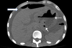 Simple computed tomography of the abdomen with abundant free fluid in cavity, thickened gastric walls and free air in cavity.