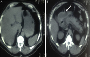 (A) Simple tomography showing a lesion inside the stomach. (B) Simple abdominal tomography showing the pancreas without late complications and an image reported as probable invagination of the pylorus and duodenum (arrow).
