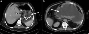 Abdominal tomography. (A) Case 1, axial plane where a pancreatic pseudocyst with transgastric drainage can be seen (arrow). (B) Case 3, axial plane with 10×20 hypodense peripancreatic collection with an average attenuation of 9 UH, compatible with liquid (arrow).
